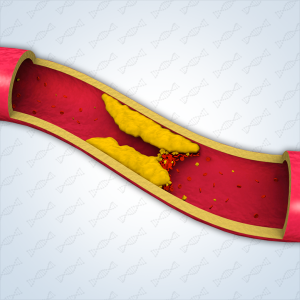 improved-cholesterol-profile-sq-300x300