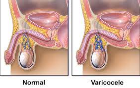 Varicoceles