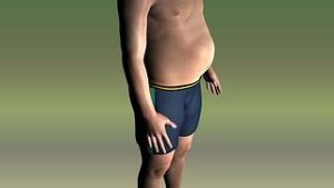 obese man 1 300x169